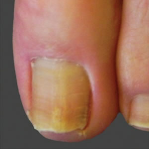 Nail Fungus pre