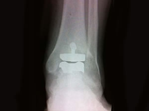total ankle replacment3