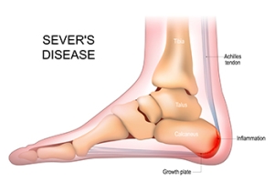 Patience Matters When Healing Sever's Disease
