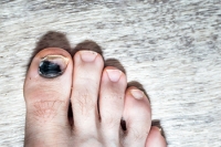 What Causes Toenails to Turn Black?