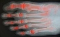 Joint Soreness in the Feet With Rheumatoid Arthritis