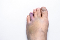 Toes May Fracture Easily