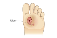 How Podiatrists Treat Diabetic Foot Ulcers