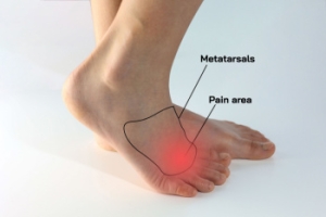 Facts About Morton’s Neuroma