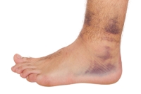Dealing With Ankle Pain From Tendonitis