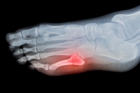Broken Toe Symptoms and Podiatric Care