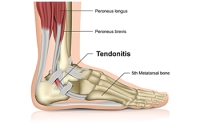 Causes and Symptoms of Achilles Tendinitis