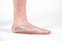 Flat Feet and the Impact on Foot Health