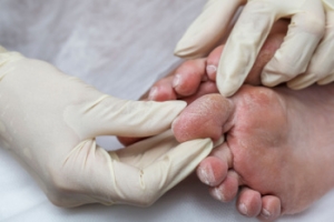 Diabetes Foot Health and Preventive Care